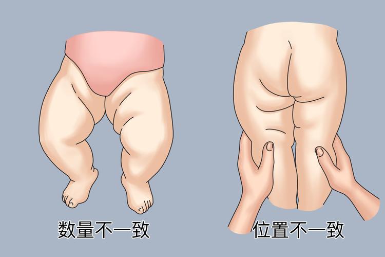 新生儿小腿肌肉粗细不一,是发育异常还是正常现象?-第1张图片-郑州医学网 新生儿小腿肌肉粗细不一,是发育异常还是正常现象?-第1张图片-郑州医学网
