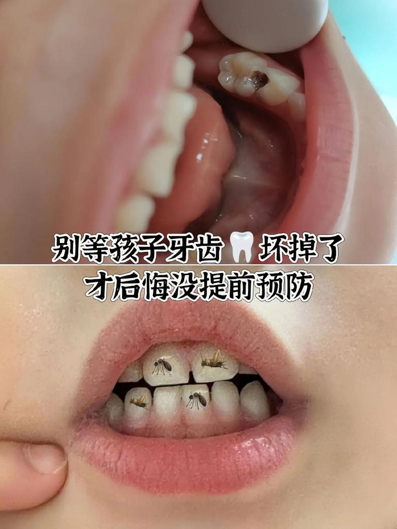 儿童有蛀牙不治会自己好吗？乳牙蛀了不管会影响恒牙吗？-第2张图片-郑州医学网