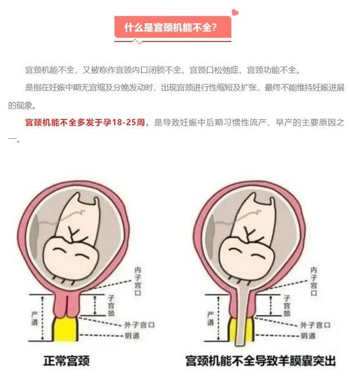 孕期宫颈长度短会影响胎儿吗？需要哪些保胎措施？-第1张图片-郑州医学网