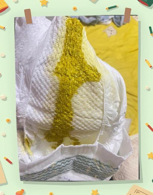 新生儿粑粑奶瓣和粘液-第1张图片-郑州医学网