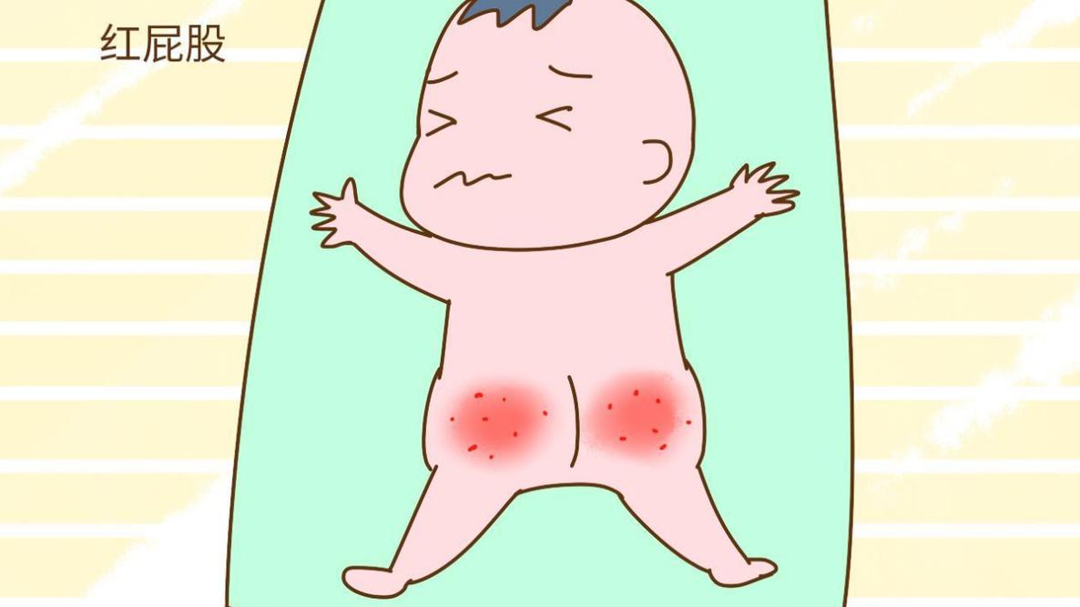 新生儿屁股上长尿布疹，到底该如何科学护理才能快速缓解？-第3张图片-郑州医学网