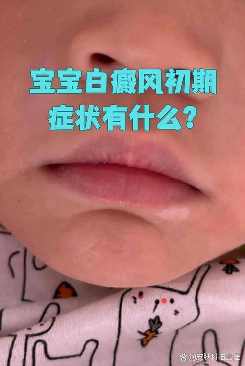 新生儿皮肤白是遗传吗-第3张图片-郑州医学网