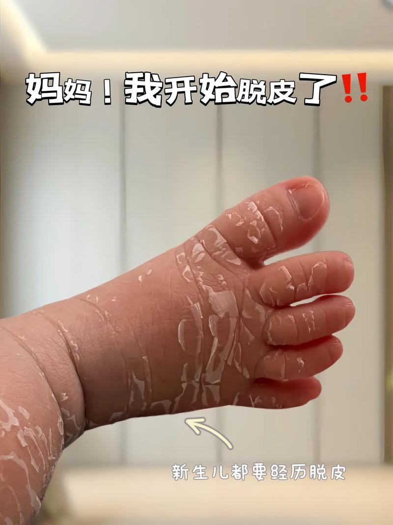 新生儿脸上也会掉皮吗-第2张图片-郑州医学网