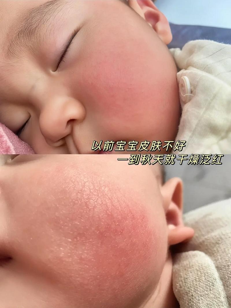 新生儿脸上也会掉皮吗-第1张图片-郑州医学网