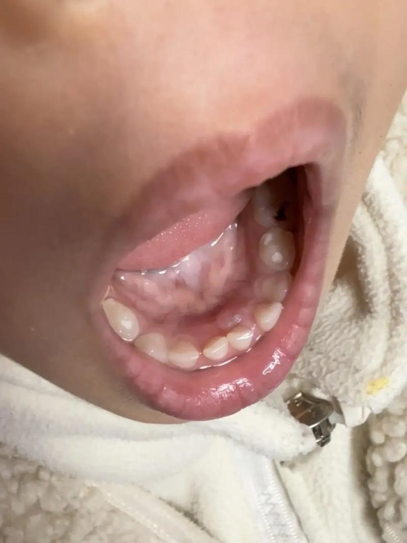 儿童乳牙未脱落就长恒牙，是牙齿排列异常还是发育问题？-第1张图片-郑州医学网