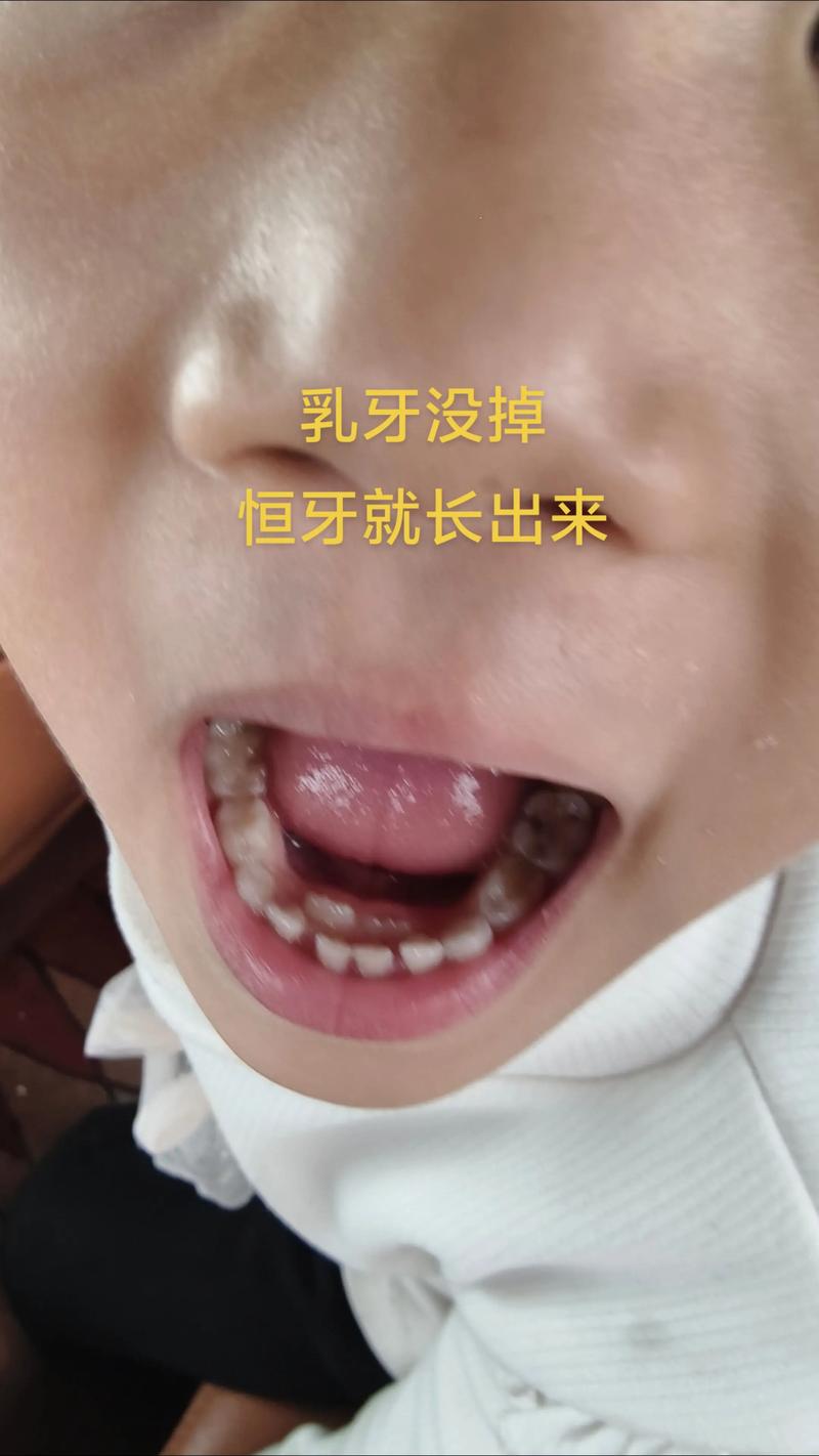 儿童乳牙未脱落就长恒牙，是牙齿排列异常还是发育问题？-第2张图片-郑州医学网