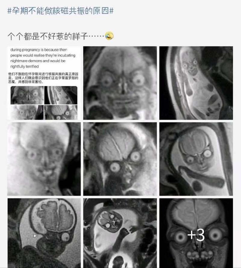 孕期到底能不能做核磁共振？对胎儿安全吗？医生会怎么建议？-第2张图片-郑州医学网
