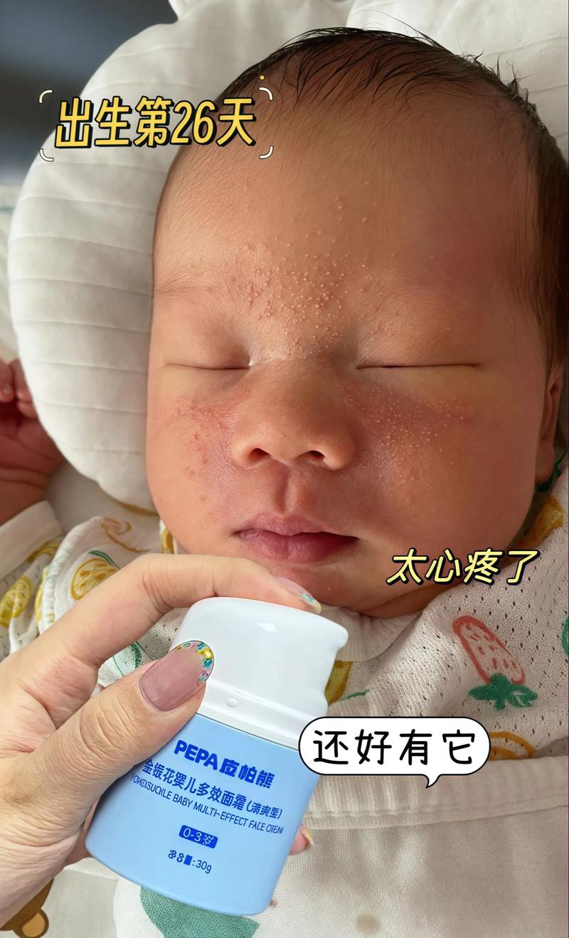 新生儿湿疹金银花洗脸-第1张图片-郑州医学网