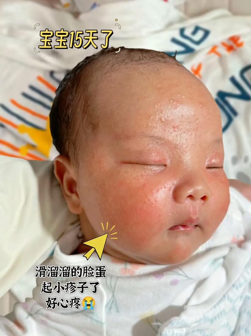 新生儿湿疹金银花洗脸-第2张图片-郑州医学网