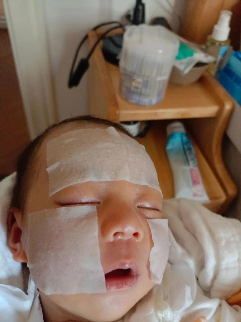 新生儿湿疹金银花洗脸-第3张图片-郑州医学网