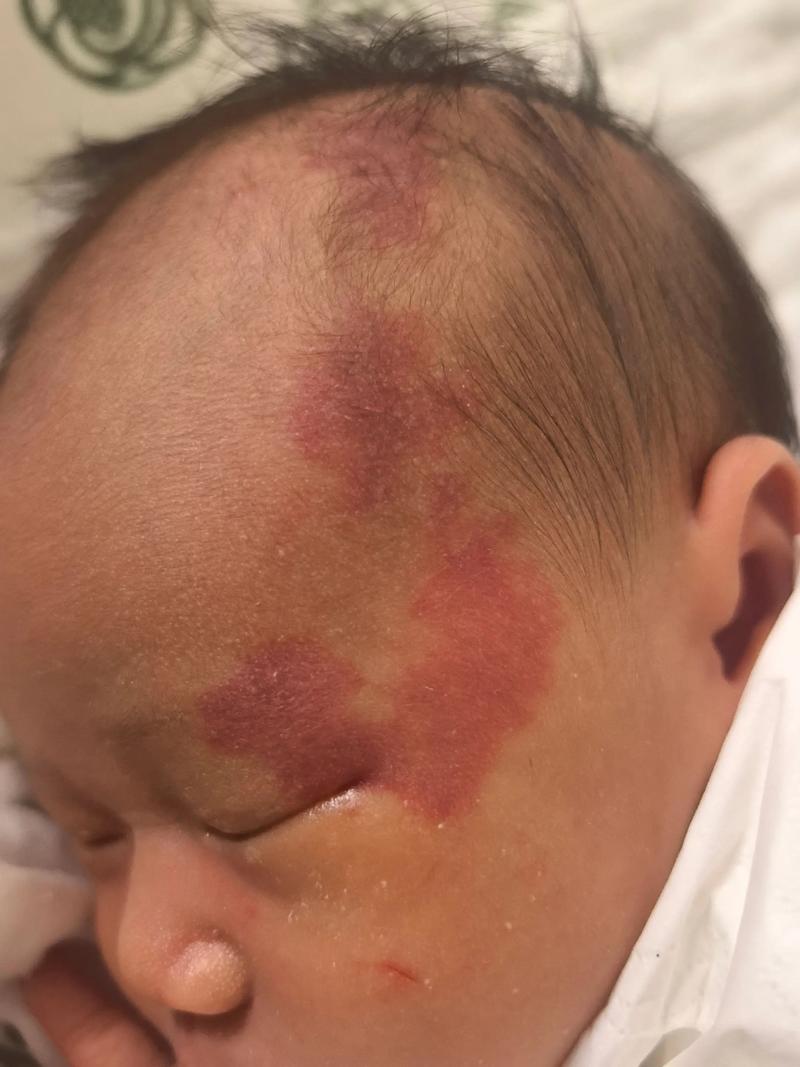新生儿鲜红斑痣有哪些典型特征？需要与哪些疾病区分？-第1张图片-郑州医学网