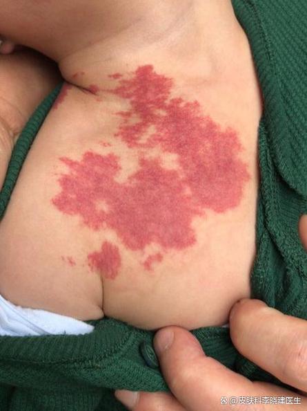 新生儿鲜红斑痣有哪些典型特征？需要与哪些疾病区分？-第2张图片-郑州医学网
