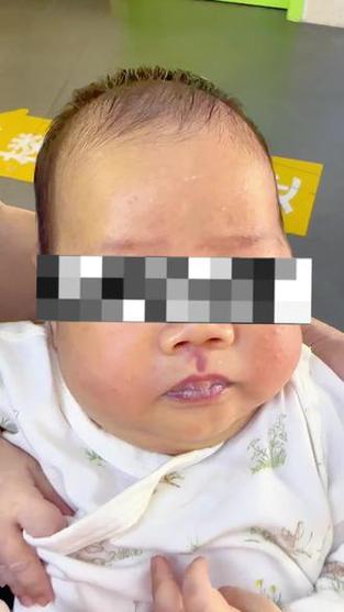 新生儿鲜红斑痣有哪些典型特征？需要与哪些疾病区分？-第3张图片-郑州医学网