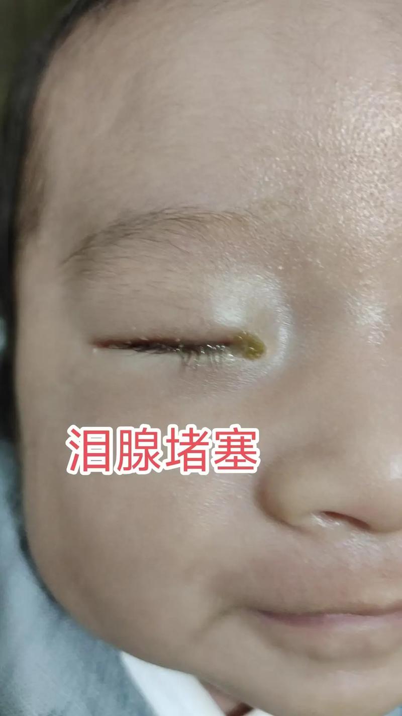 新生儿先天性泪道阻塞不流泪就没事吗？需要治疗吗？-第1张图片-郑州医学网