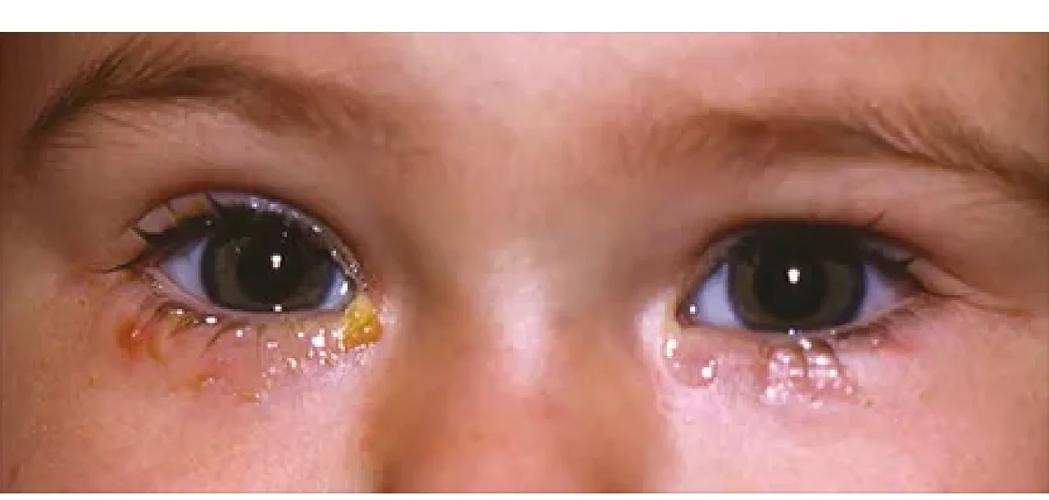 新生儿先天性泪道阻塞不流泪就没事吗？需要治疗吗？-第2张图片-郑州医学网