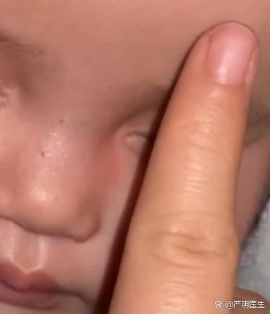 新生儿先天性泪道阻塞不流泪就没事吗？需要治疗吗？-第3张图片-郑州医学网