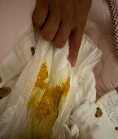 新生儿拉屎有酸臭味是正常现象还是消化异常信号？-第1张图片-郑州医学网