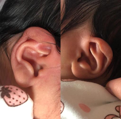 新生儿耳朵里会有胎脂吗？需要清理吗？对听力有影响吗？-第1张图片-郑州医学网