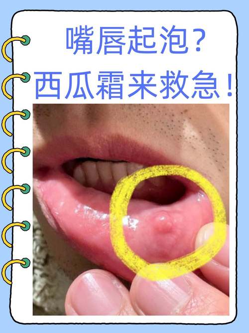 怀孕期间上火嘴巴起泡，到底该怎么办才能快速缓解又不伤胎儿？-第3张图片-郑州医学网