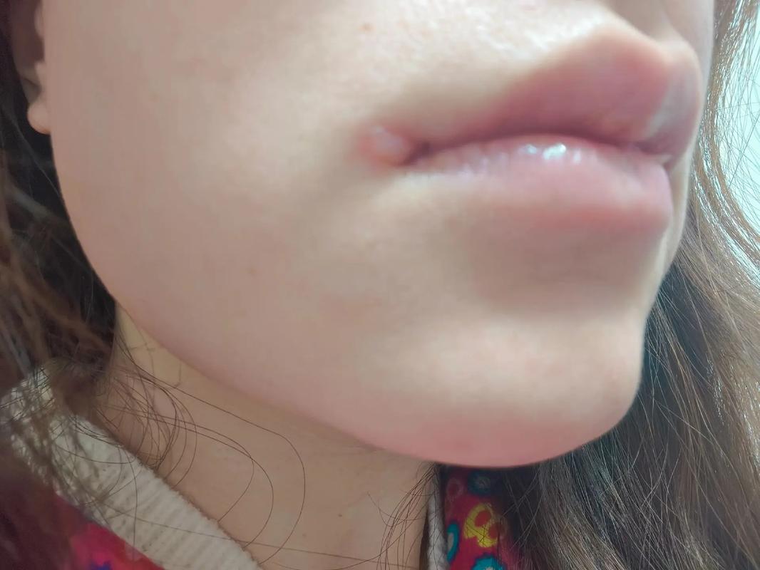 怀孕期间上火嘴巴起泡，到底该怎么办才能快速缓解又不伤胎儿？-第2张图片-郑州医学网