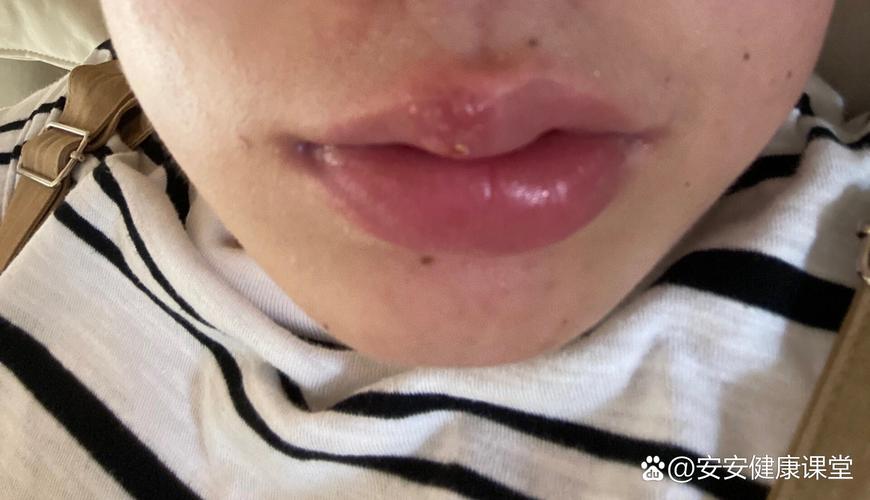 怀孕期间上火嘴巴起泡，到底该怎么办才能快速缓解又不伤胎儿？-第1张图片-郑州医学网