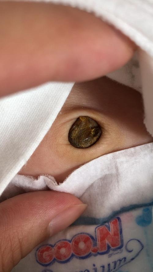 新生儿脐带未脱落且发白是正常现象还是异常信号?-第1张图片-郑州医学网 新生儿脐带未脱落且发白是正常现象还是异常信号?-第1张图片-郑州医学网