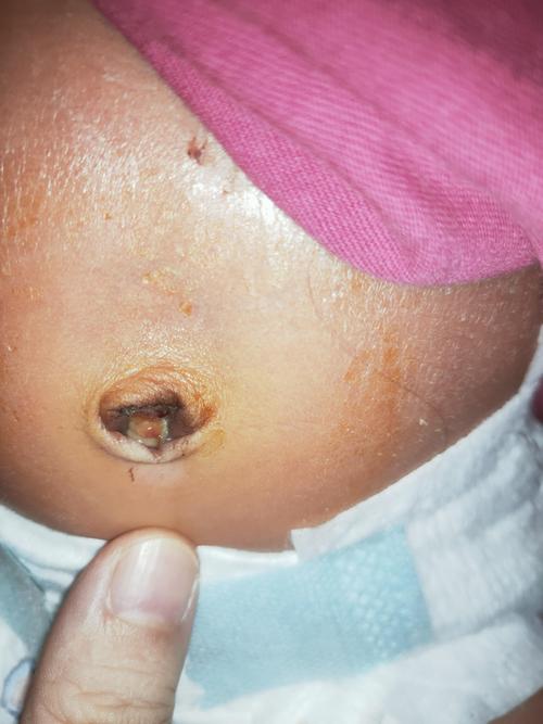 新生儿脐带未脱落且发白是正常现象还是异常信号？-第2张图片-郑州医学网