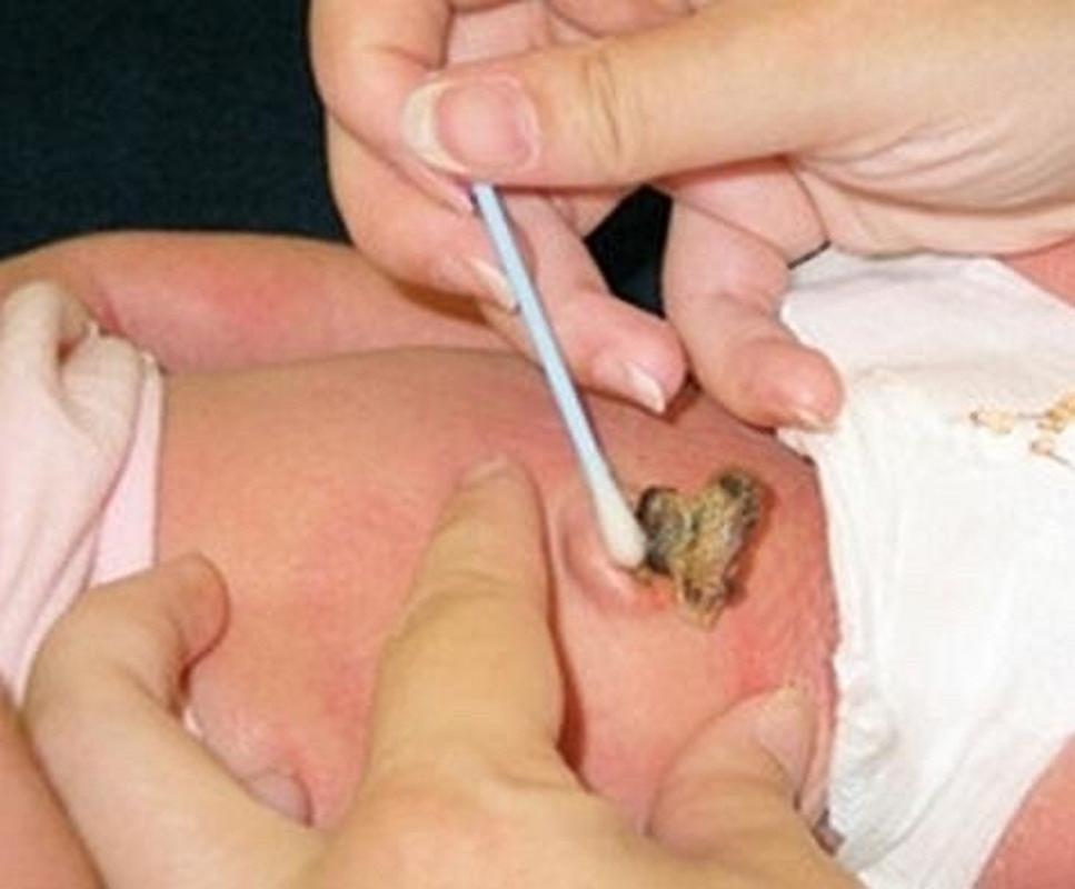 新生儿脐带未脱落且发白是正常现象还是异常信号？-第3张图片-郑州医学网