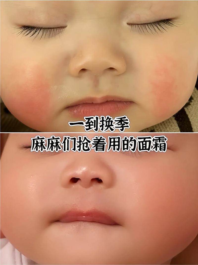 新生儿皮肤娇嫩，脸上到底需不需要涂面霜？涂了会不会有负担？-第2张图片-郑州医学网