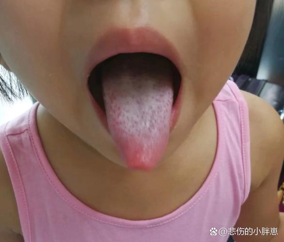 新生儿舌头发白是积食信号？需警惕哪些潜在健康问题？-第2张图片-郑州医学网