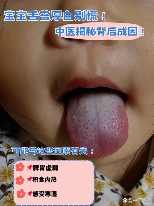 新生儿舌头发白是积食信号？需警惕哪些潜在健康问题？-第3张图片-郑州医学网