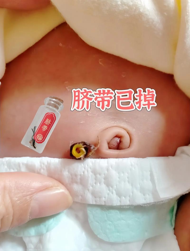 新生儿肚脐眼脱落过程是自然愈合还是有异常情况？-第3张图片-郑州医学网