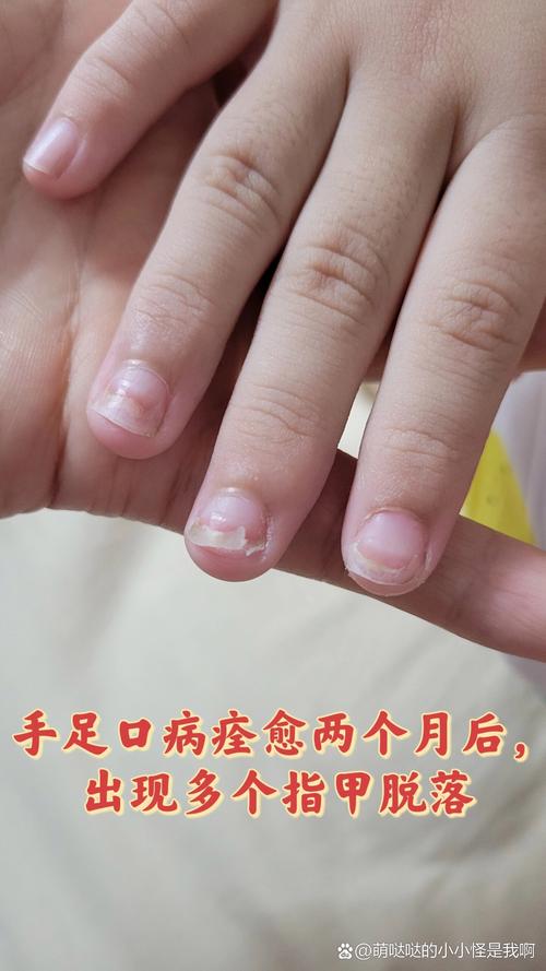 手足口病后儿童指甲脱落是正常恢复现象还是异常信号？-第1张图片-郑州医学网