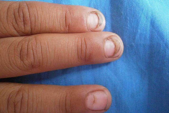 手足口病后儿童指甲脱落是正常恢复现象还是异常信号？-第3张图片-郑州医学网