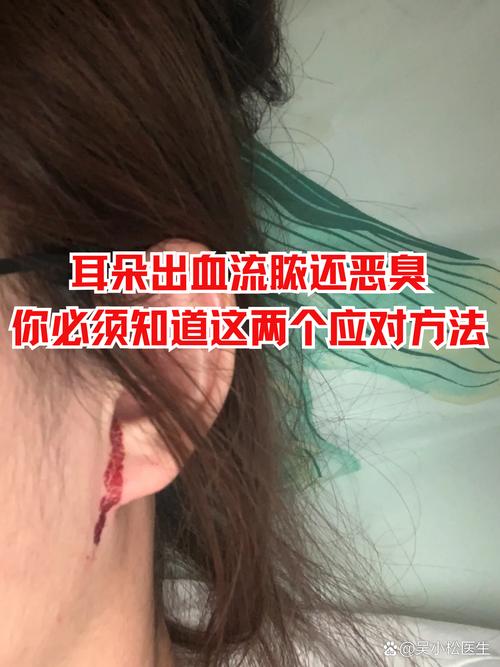 儿童耳朵流血是外伤还是中耳炎？家长该如何紧急处理与就医？-第3张图片-郑州医学网
