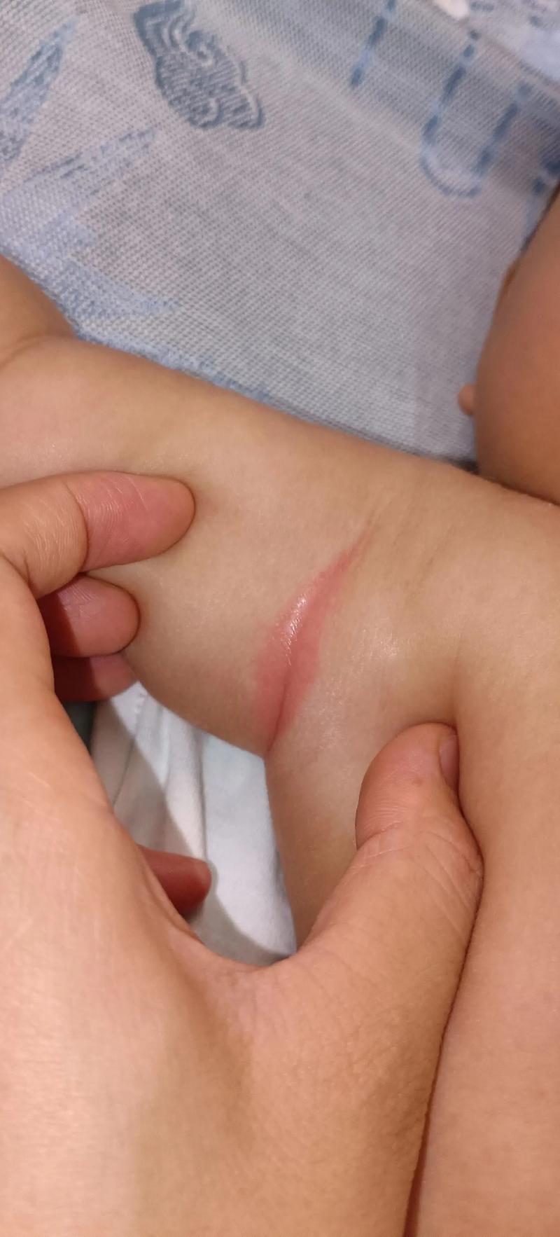 新生儿腋下发红是皮肤过敏还是护理不当？这样处理才正确！-第1张图片-郑州医学网