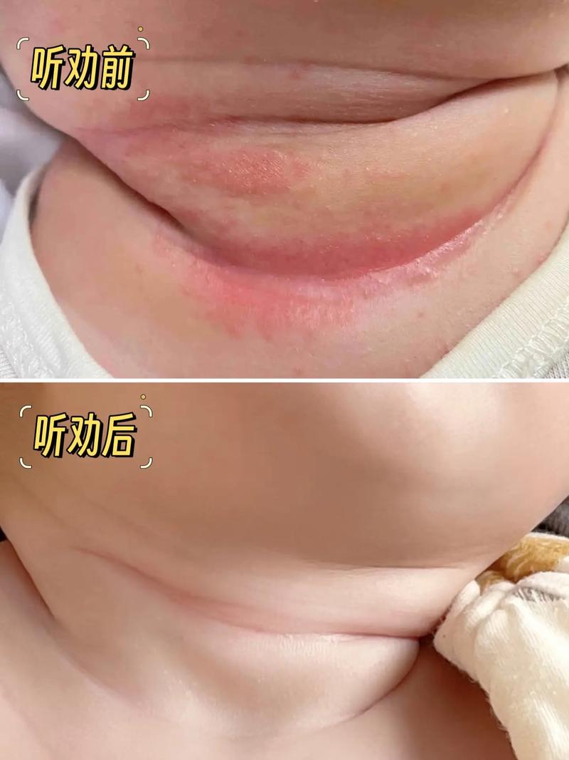 新生儿腋下发红是皮肤过敏还是护理不当？这样处理才正确！-第2张图片-郑州医学网
