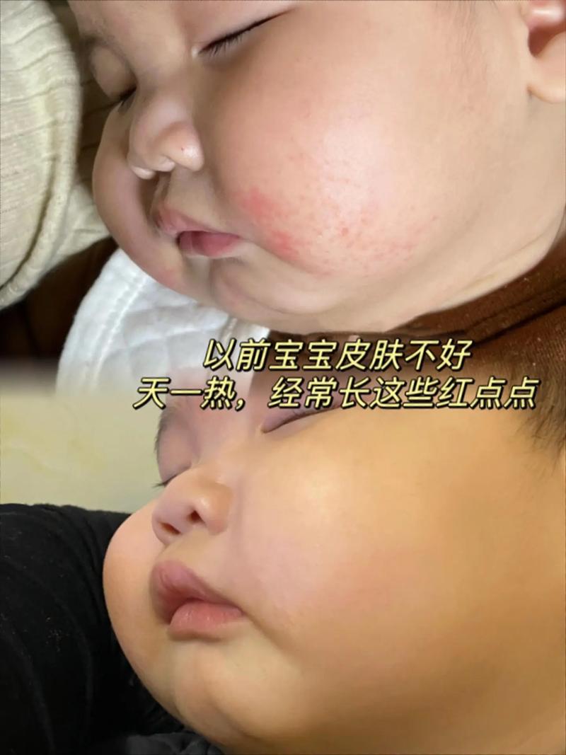 新生儿脸部皮肤娇嫩，到底该不该抹油？抹油会不会堵塞毛孔？抹什么油合适？-第2张图片-郑州医学网