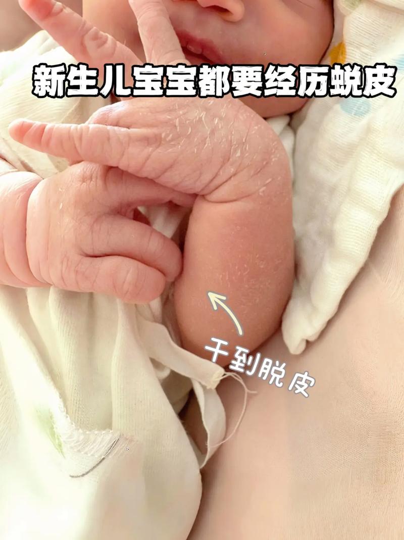 新生儿脸部皮肤娇嫩，到底该不该抹油？抹油会不会堵塞毛孔？抹什么油合适？-第3张图片-郑州医学网
