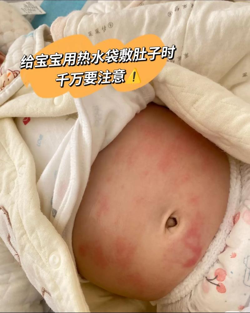 新生儿热敷肚子多少度才合适?温度过高会烫伤宝宝吗?-第1张图片-郑州医学网 新生儿热敷肚子多少度才合适?温度过高会烫伤宝宝吗?-第1张图片-郑州医学网