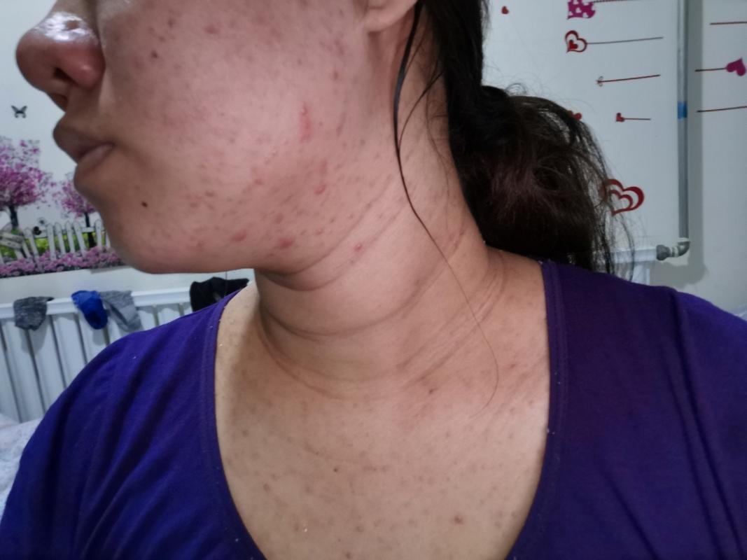 孕期脸上长粉刺严重，该怎么办才能安全又有效呢？-第1张图片-郑州医学网