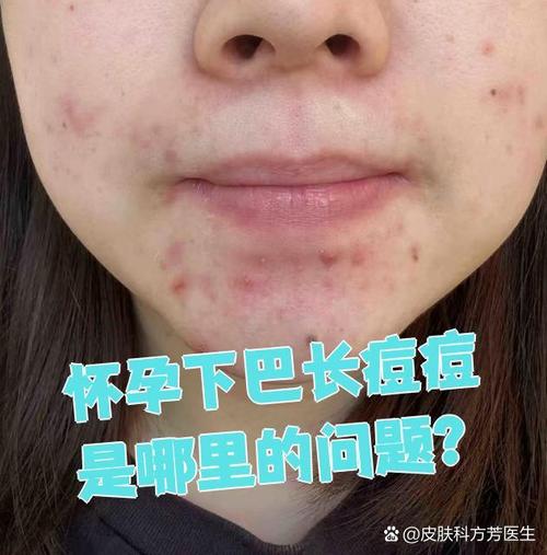 孕期脸上长粉刺严重，该怎么办才能安全又有效呢？-第3张图片-郑州医学网