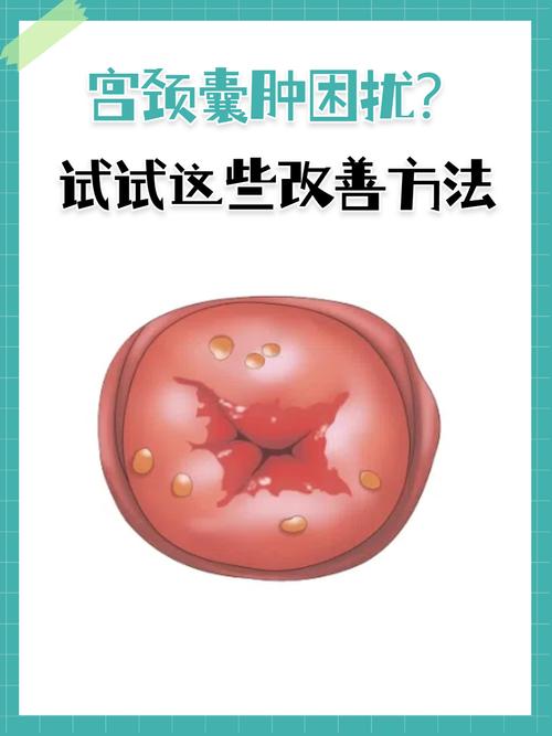孕期囊肿易扭转，如何科学预防才能保障母婴安全？-第2张图片-郑州医学网
