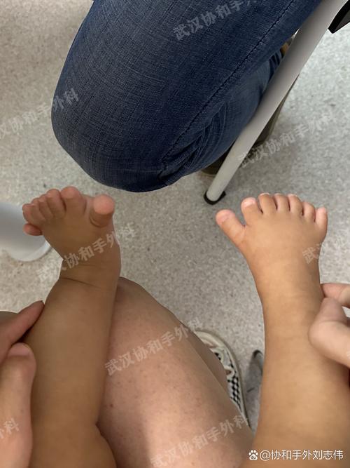 新生儿睡觉脚总是弯曲，是正常生理现象还是需要干预的信号？-第1张图片-郑州医学网