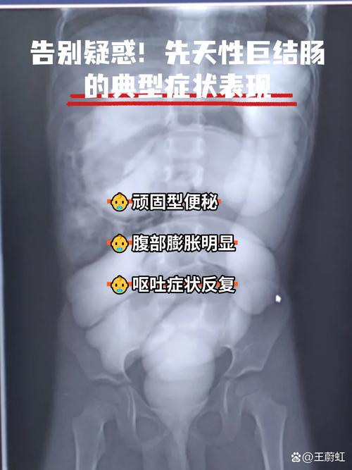 新生儿巨结肠手术风险高吗？术后并发症如何应对？-第2张图片-郑州医学网