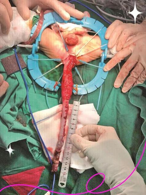 新生儿巨结肠手术风险高吗？术后并发症如何应对？-第3张图片-郑州医学网