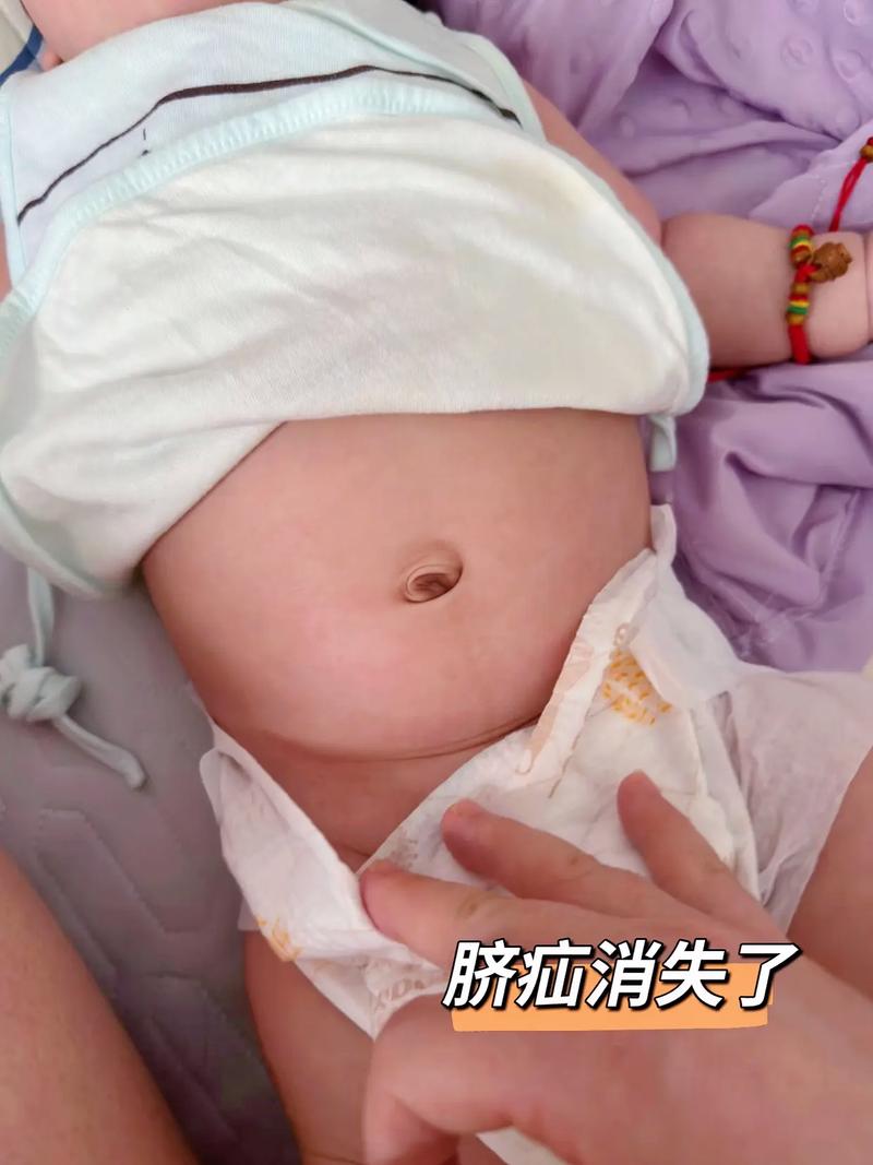 新生儿肚脐凸起是正常现象还是异常信号？家长该如何正确护理与应对？-第1张图片-郑州医学网