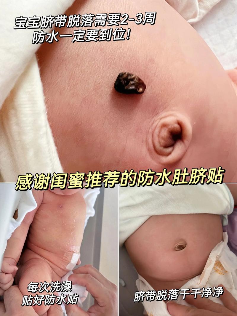 新生儿脐带和纱布粘连后，家长该如何正确处理才能避免感染？-第2张图片-郑州医学网