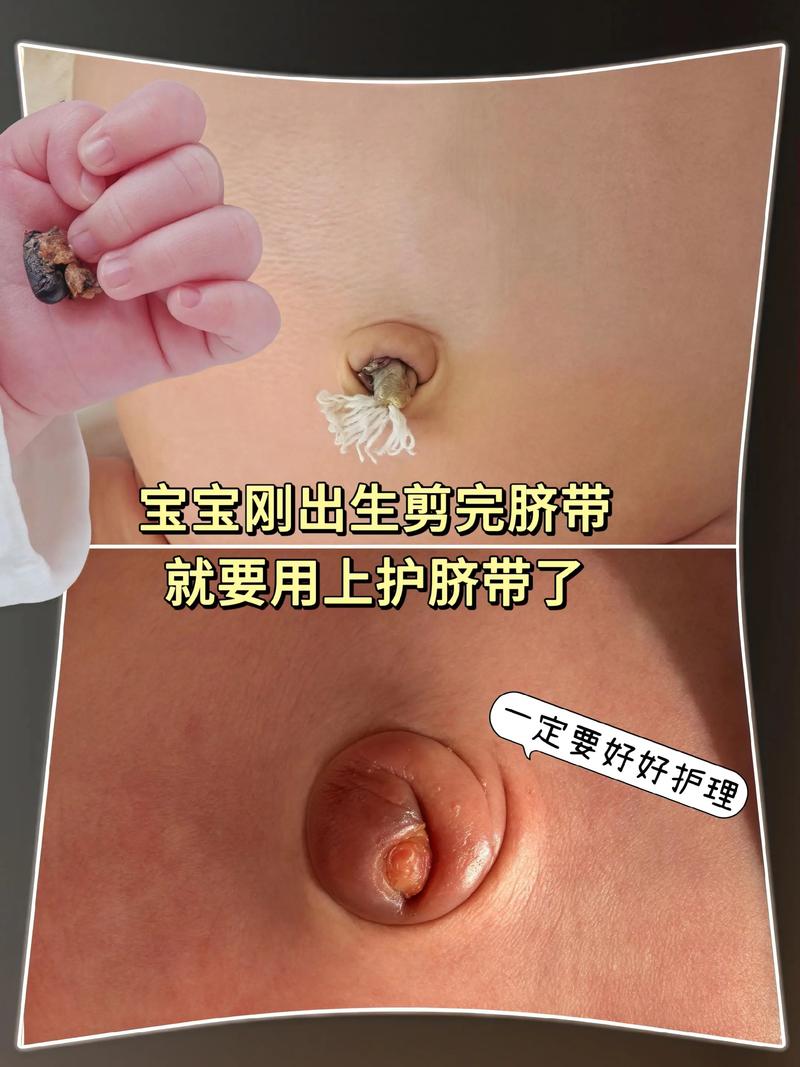 新生儿脐带和纱布粘连后，家长该如何正确处理才能避免感染？-第3张图片-郑州医学网
