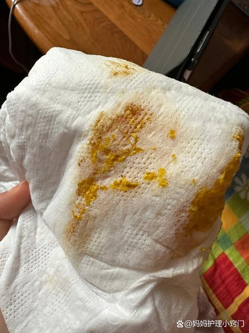 新生儿便血是否必须住院？家长如何判断风险与应对措施？-第2张图片-郑州医学网